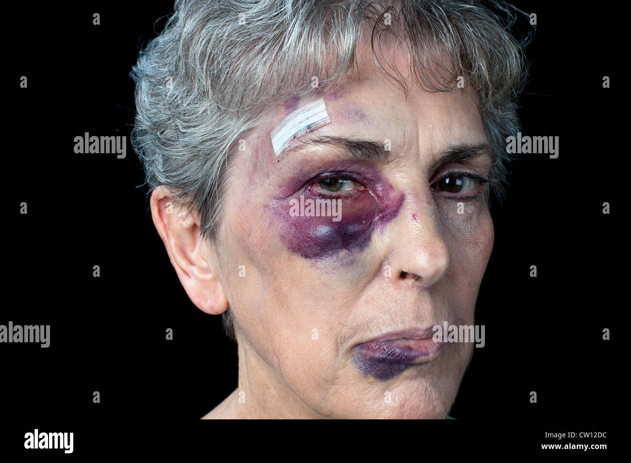 Une vieille grand-mère gravement battue avec des points de suture, un œil noir et une grosse lèvre. Banque D'Images