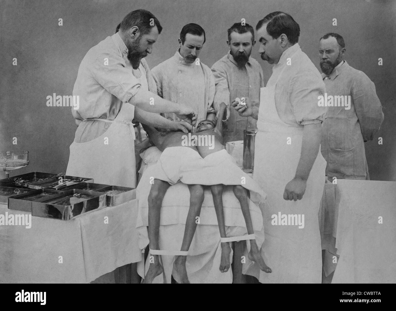 L'opération 1912 jeunes Indiens de séparation des frères siamois Twin Sisters, Radica & Doodica, par le célèbre chirurgien français, Eugene-Louis Doyen Banque D'Images