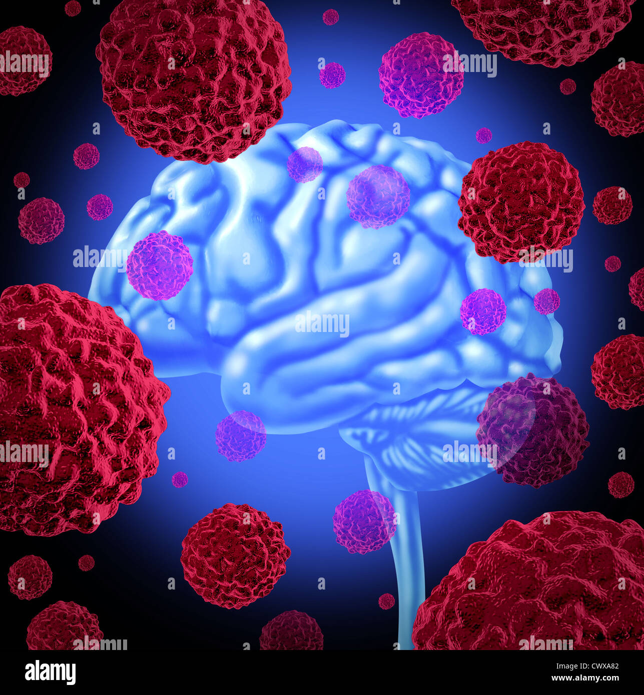 Cancer du cerveau humain avec les cellules en croissance et propagation de cellules malignes chez l'homme causés par les agents cancérigènes et les causes génétiques comme la borne de tumeurs et de lésions cellulaires sont traités à guérir la maladie. Banque D'Images