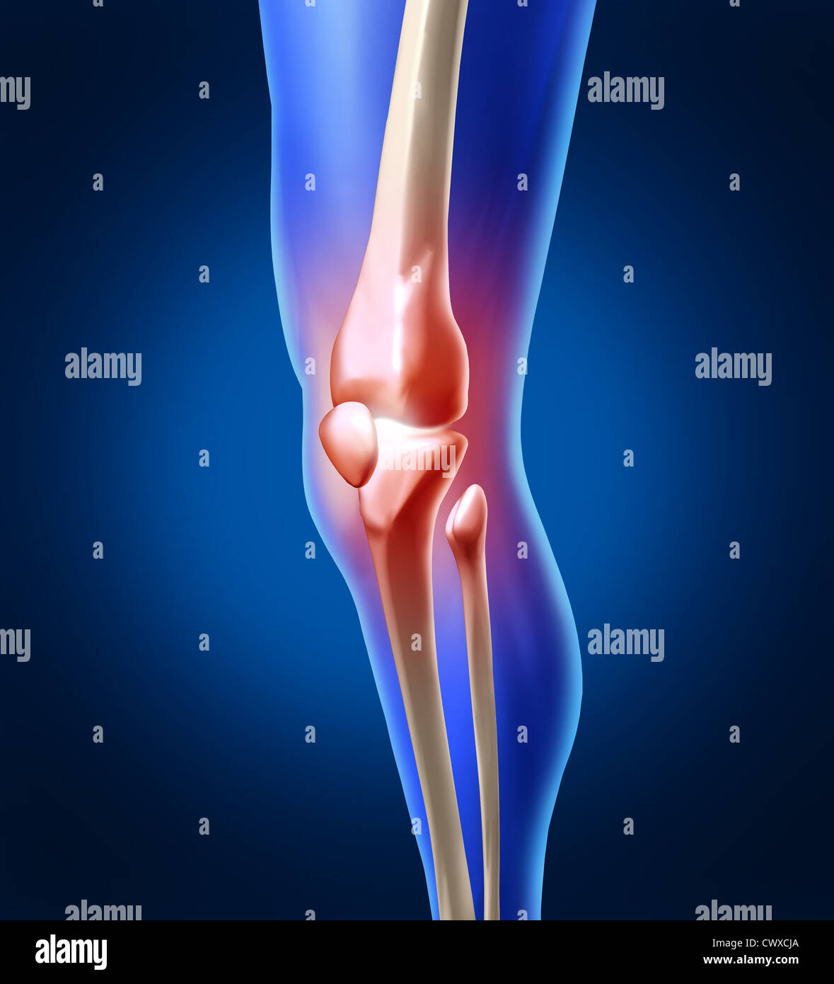 Les douleurs au genou avec l'anatomie d'un squelette de jambe et montrant l'intérieur d'inflammation de l'articulation douloureuse qui a besoin de la chirurgie orthopédique et la thérapie physique en tant que professionnel de la santé et de la médecine ou des blessures sportives médical concept. Banque D'Images