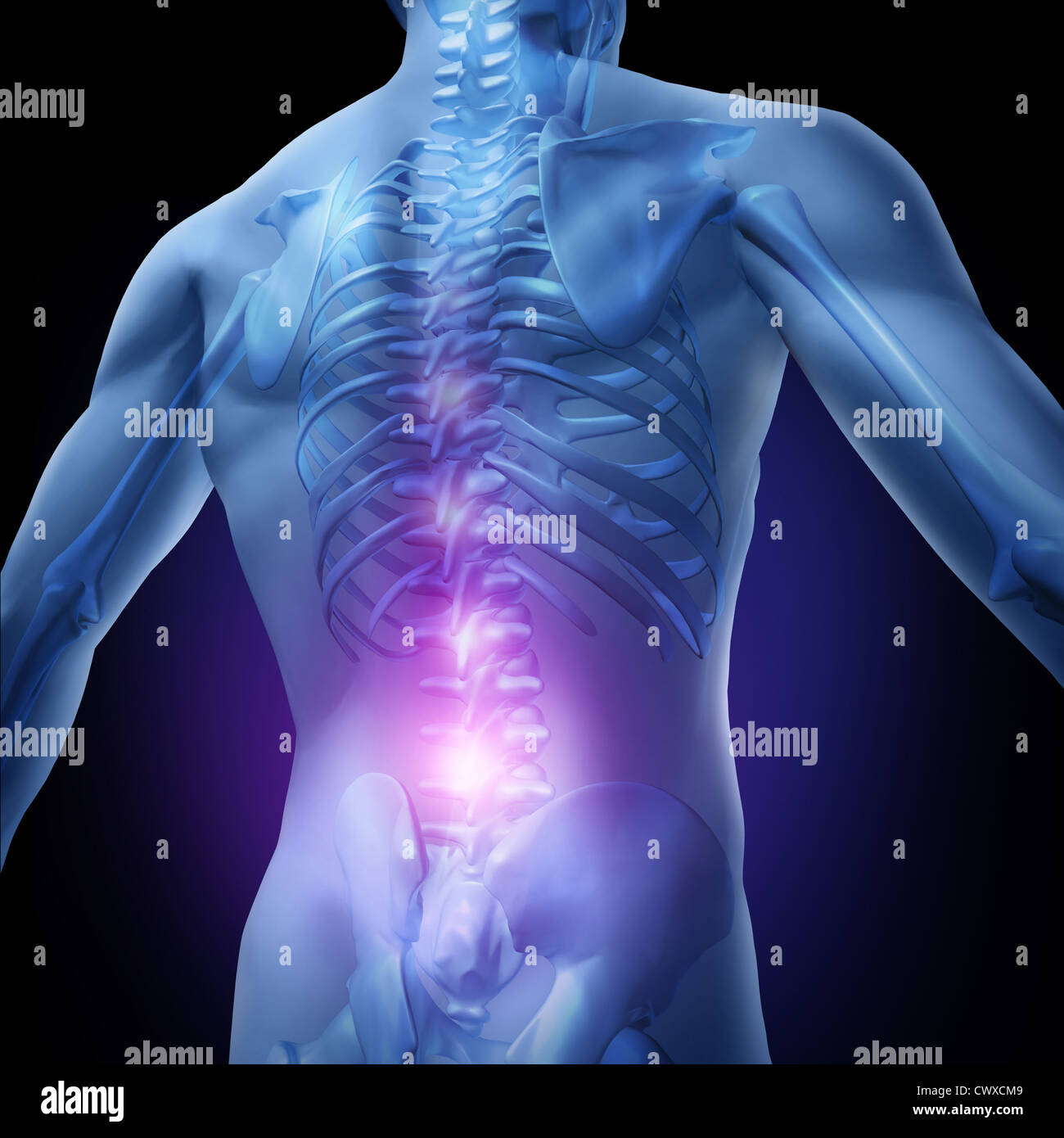 Douleurs au bas du dos et les maux de dos avec le haut du torse d'un  squelette du corps montrant la colonne vertébrale et de la colonne  vertébrale en surbrillance rougeoyant comme