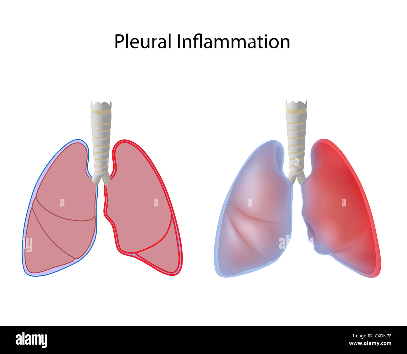 L'inflammation de la plèvre, une pleurésie Banque D'Images