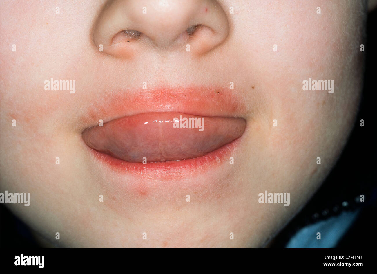 Perioral dermatitis rash around lips Banque de photographies et d’images à haute résolution Alamy