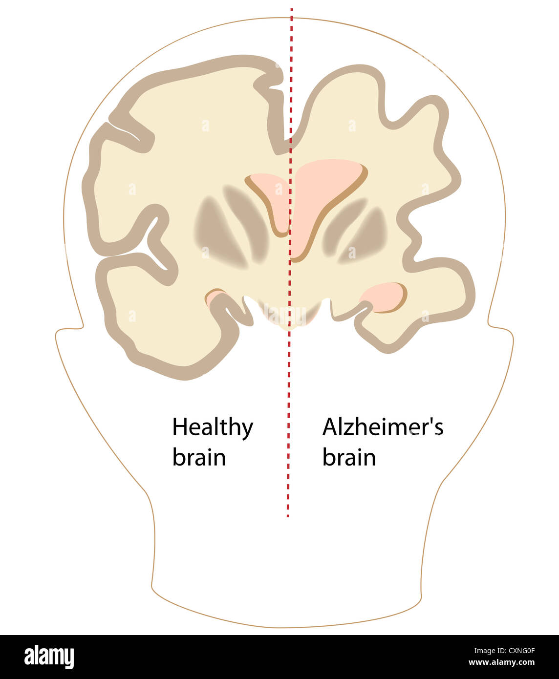 La maladie d'Alzheimer cerveau par rapport à la normale Banque D'Images