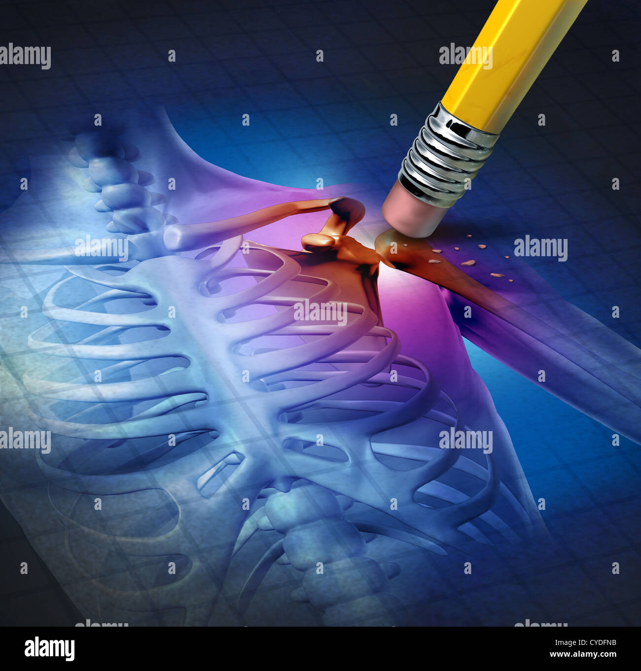 Les droits de l'épaule La douleur avec un x-ray d'une anatomie du corps  avec la zone douloureuse d'être effacées par un crayon comme un symbole  médical de soins de santé d'un traitement