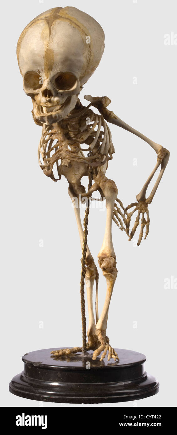 Squelette allemand préparé pour des études pathologiques ou anatomiques,19e siècle préparé avec soin,squelette complet d'un nouveau-né avec une déformation sévère de la colonne vertébrale.colonne vertébrale ouverte clairement marquée(spina bifida)avec une forte courbure de la colonne vertébrale(scoliose).monté sur une base étagée de la serpentine noirâtre.la base est légèrement bosselée.il y a aussi une cloche en verre avec un bois Base sur trois pieds de boule.hauteur du squelette 39 cm.hauteur avec la cloche de verre: 69 cm.rare, préparation de haute qualité d'une collection pour l'enseignement scientifique.le squelette,droits additionnels-Clearences-non disponible Banque D'Images