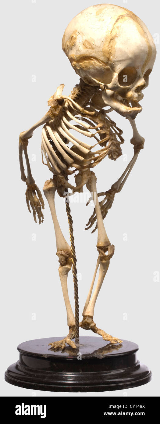Squelette Allemand Prepare Pour Des Etudes Pathologiques Ou Anatomiques 19e Siecle Prepare Avec Soin Squelette Complet D Un Nouveau Ne Avec Une Deformation Severe De La Colonne Vertebrale Colonne Vertebrale Ouverte Clairement Marquee Spina Bifida Avec