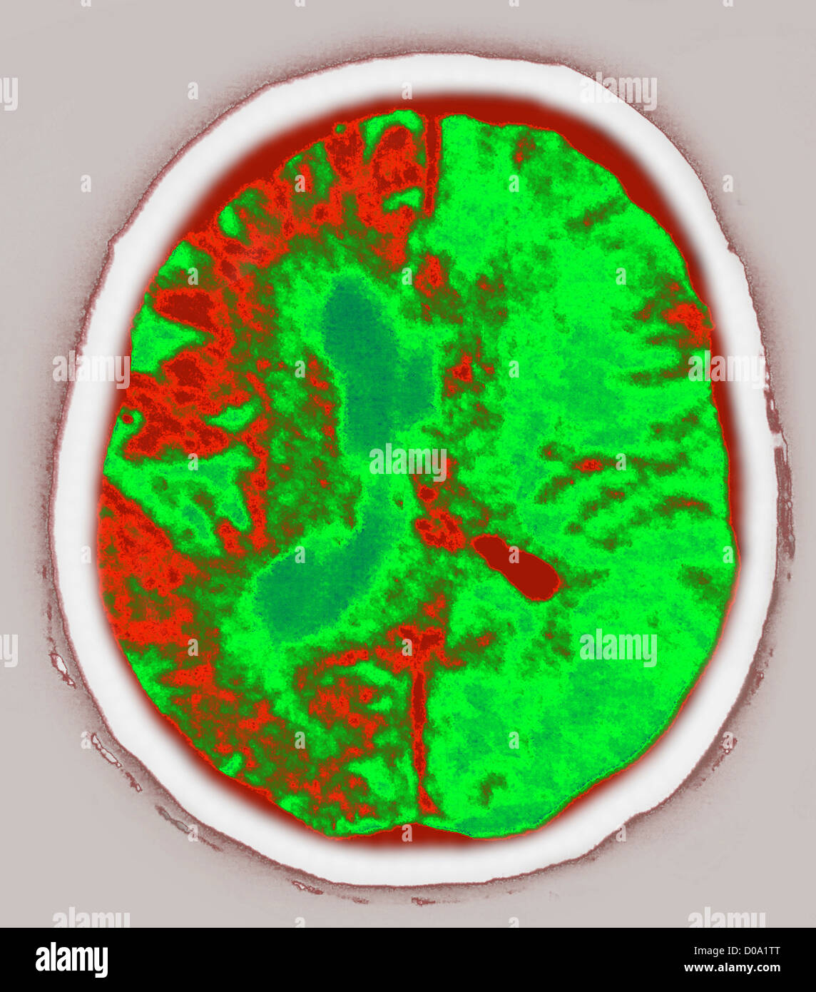 L'hémorragie, la scintigraphie cérébrale Banque D'Images