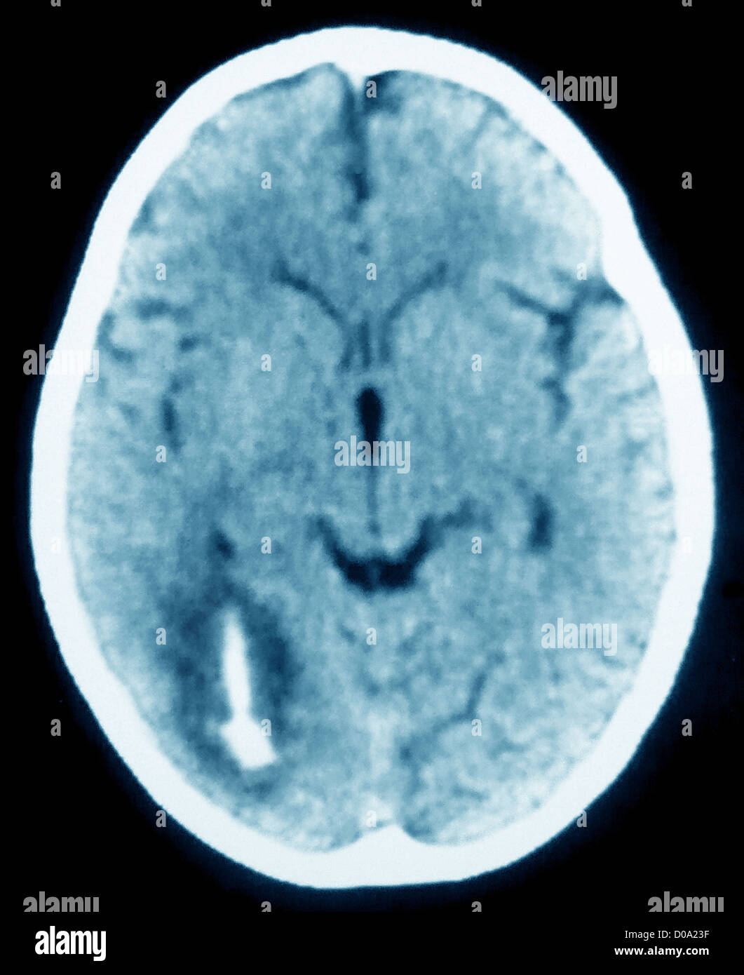L'hémorragie, la scintigraphie cérébrale Banque D'Images