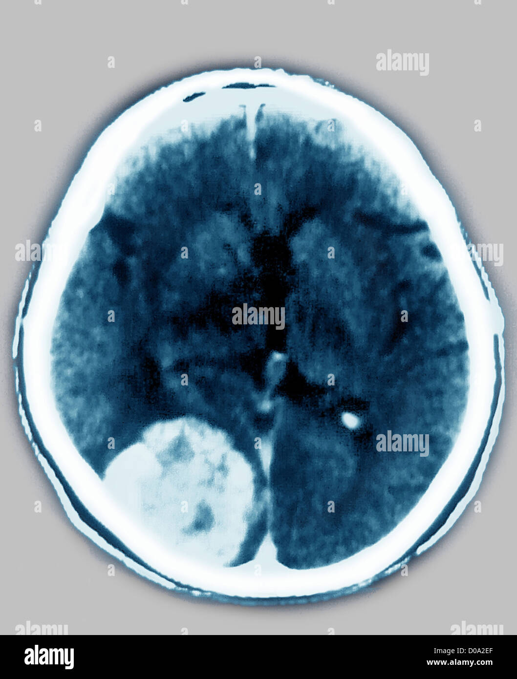 Méningiomes CT SCAN Banque D'Images