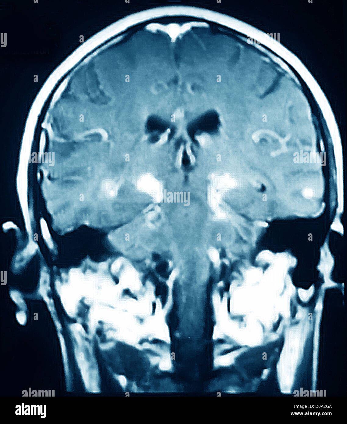 La maladie de Parkinson, l'IRM Banque D'Images