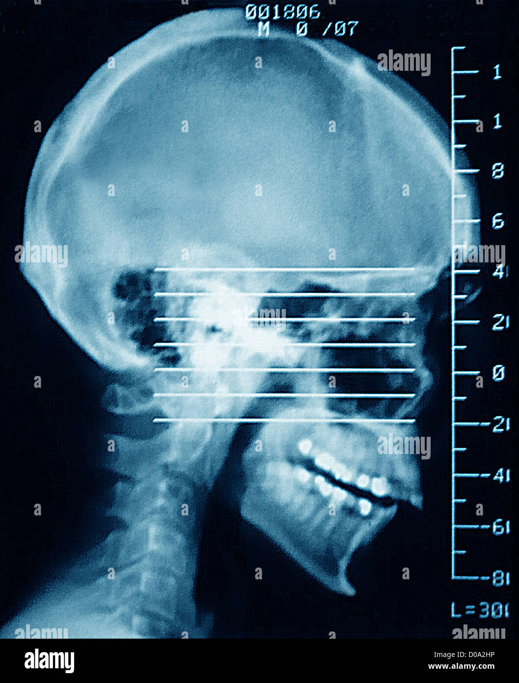 CRÂNE, SCAN Banque D'Images