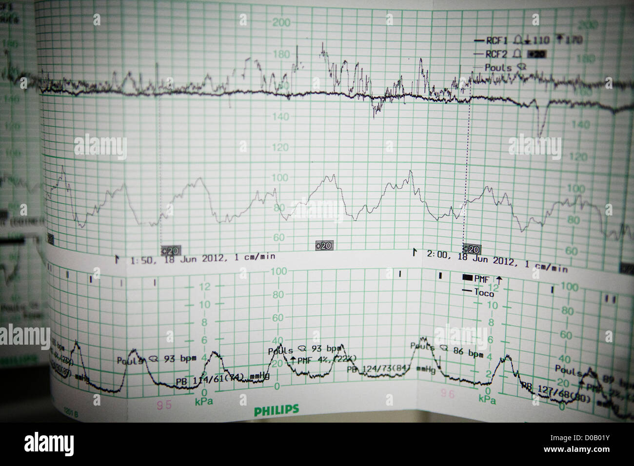 Surveillance foetale Banque D'Images