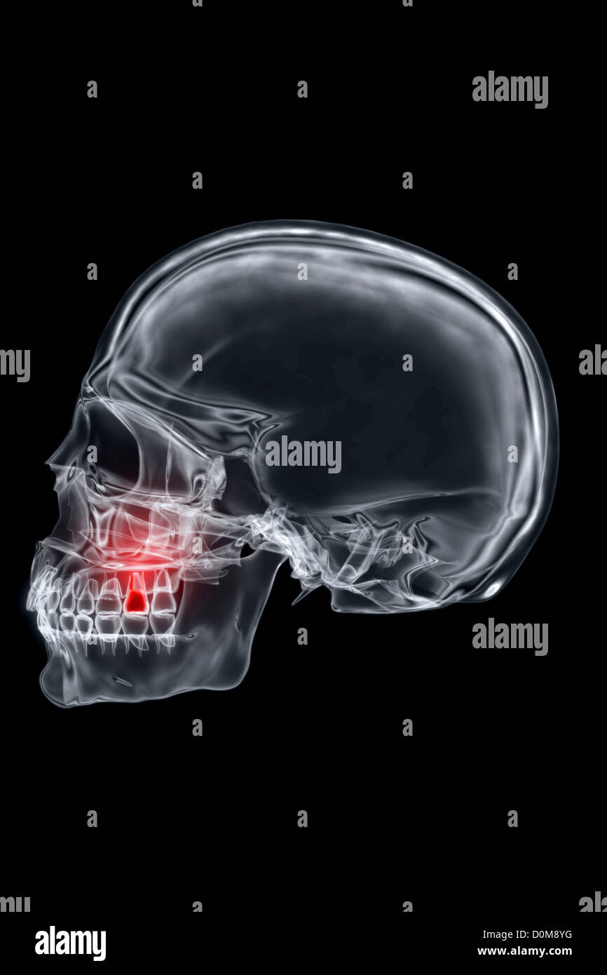 X-ray styled vue latérale du crâne. La deuxième molaire est rouge pour représenter le mal ou la douleur. Banque D'Images