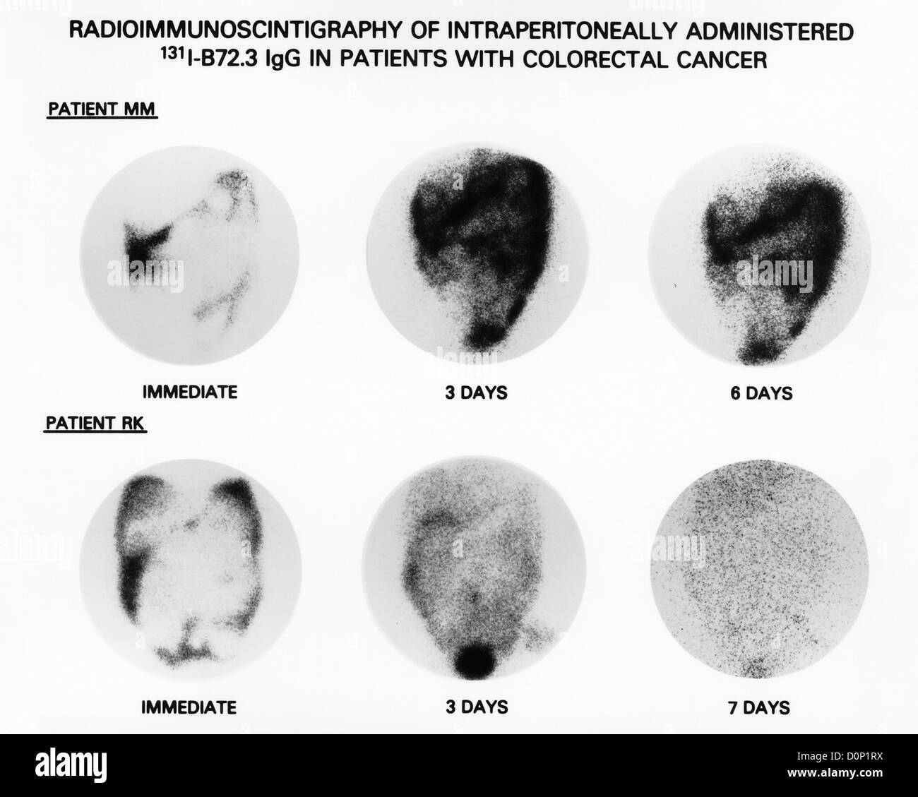 Ces analyses de la gamma-caméra (abdomen deux-points) deux patients montre des anticorps monoclonaux effets spécifiquement les cellules immunitaires clonées Banque D'Images