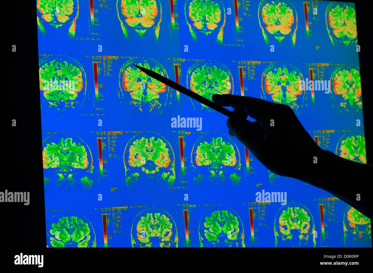 Les rayons colorés de cortex cérébral cervelet IRM du cerveau humain Banque D'Images