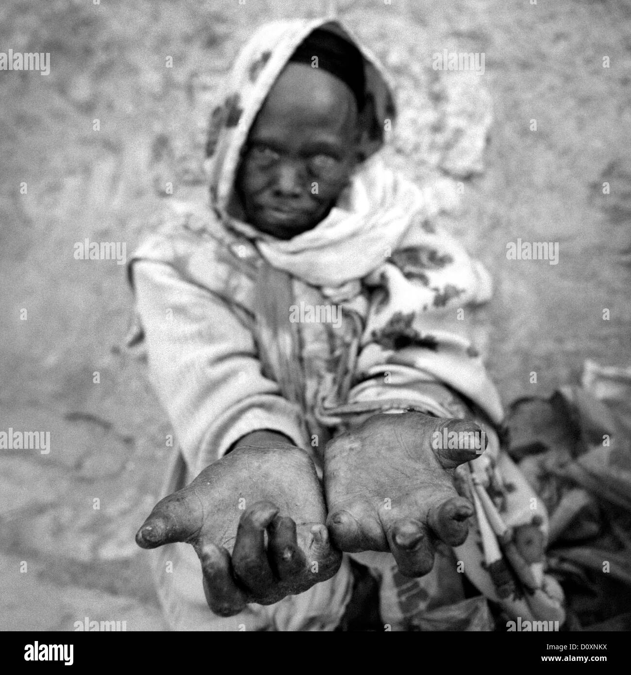 Portrait d'une femme de la Léprose montrant ses mains mutilées à Harar, en Ethiopie Banque D'Images