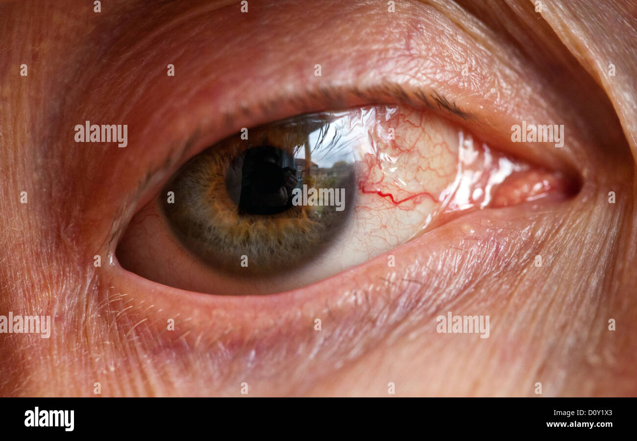Les yeux injectés de sang après une chirurgie au laser d'un décollement de  la rétine Photo Stock - Alamy
