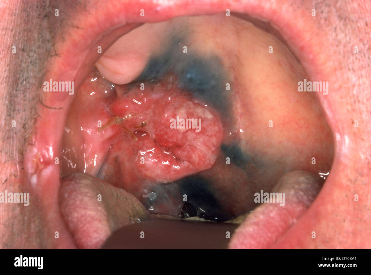 SQUAMOUS cell carcinoma (SCC) DE LA BOUCHE Banque D'Images