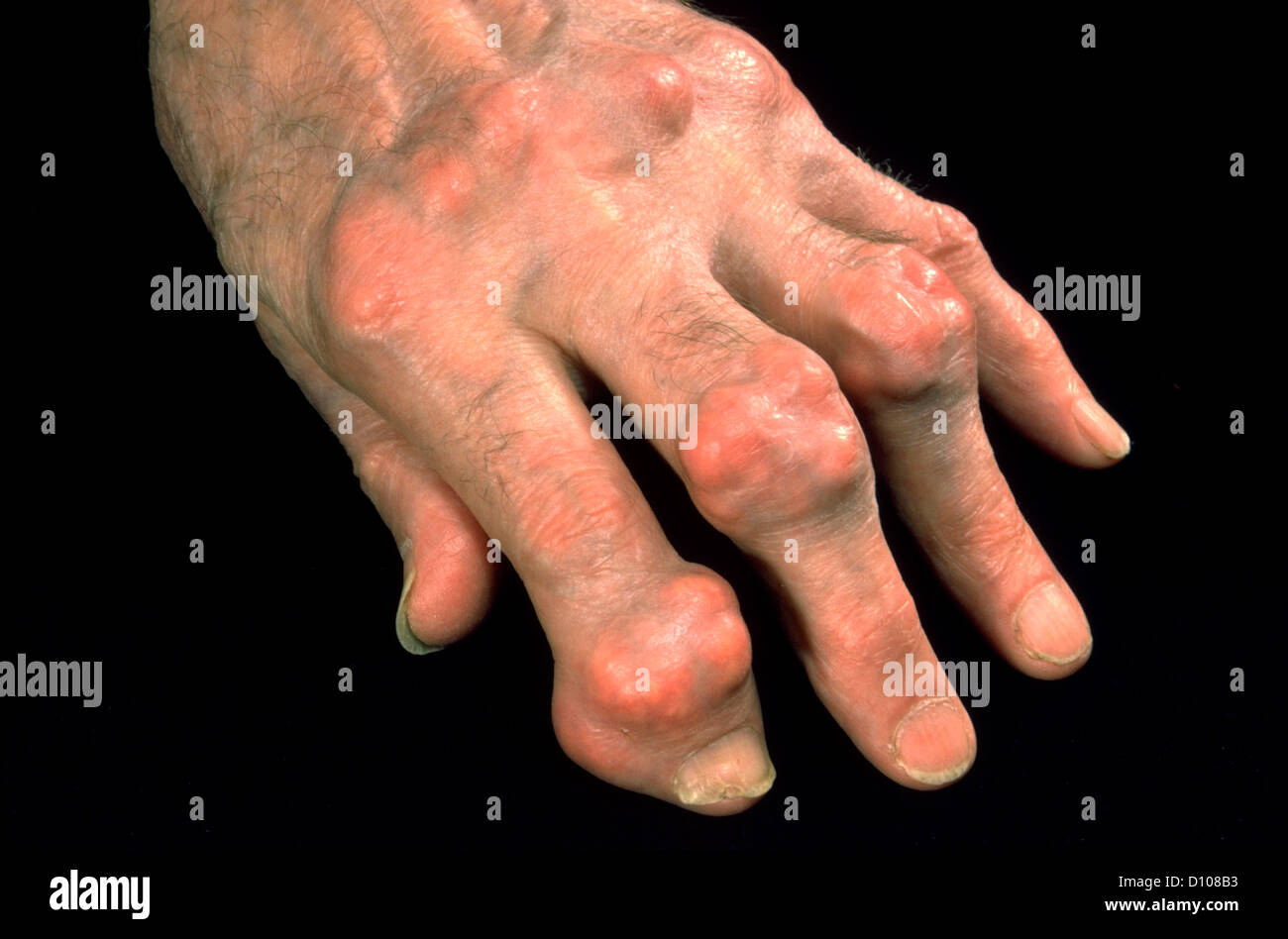 TOPHACEOUS GOUTTE Banque D'Images