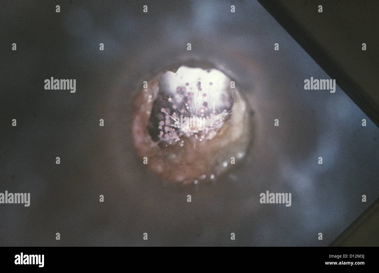L'otite externe - l'INFECTION PAR ASPERGILLUS NIGER Banque D'Images