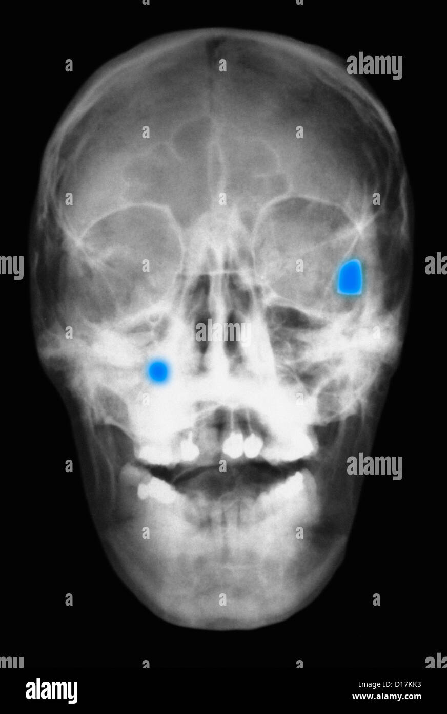 X-ray de la tête montrant deux balles dans le crâne Banque D'Images