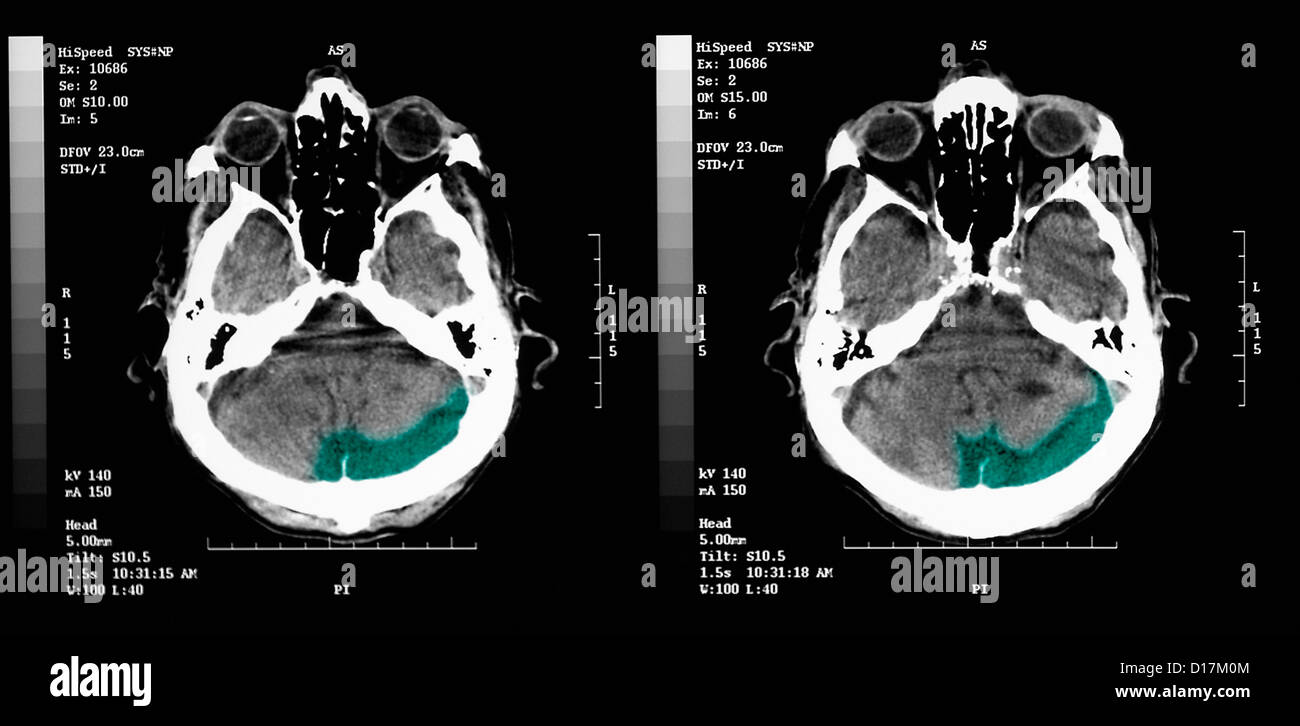 CT scan d'un homme âgé avec ancien infarctus occipital Banque D'Images