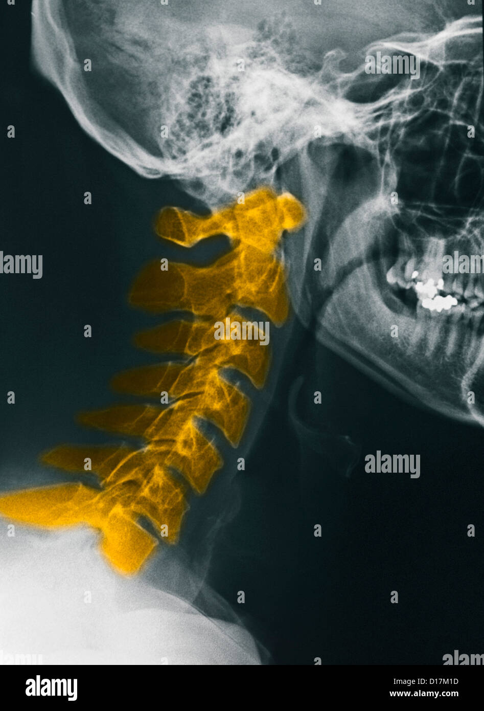 Des radiographies de la colonne cervicale, normal Banque D'Images