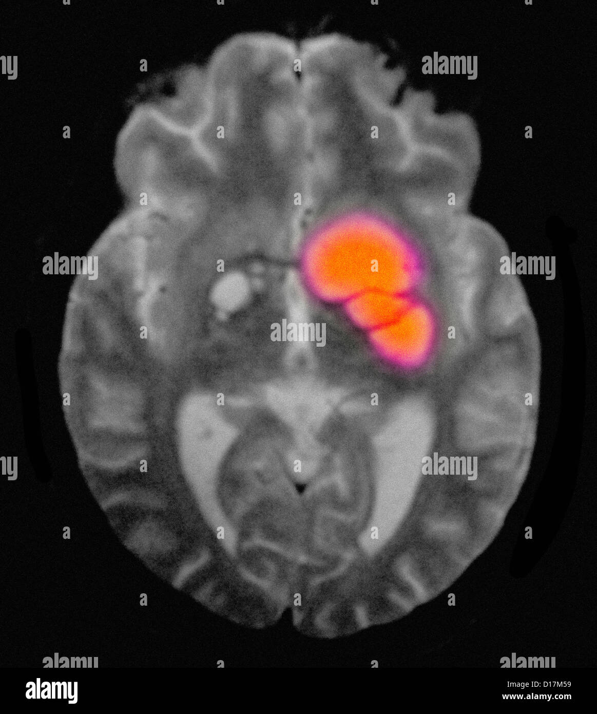 Méningite cryptococcique dans patient avec le SIDA Banque D'Images