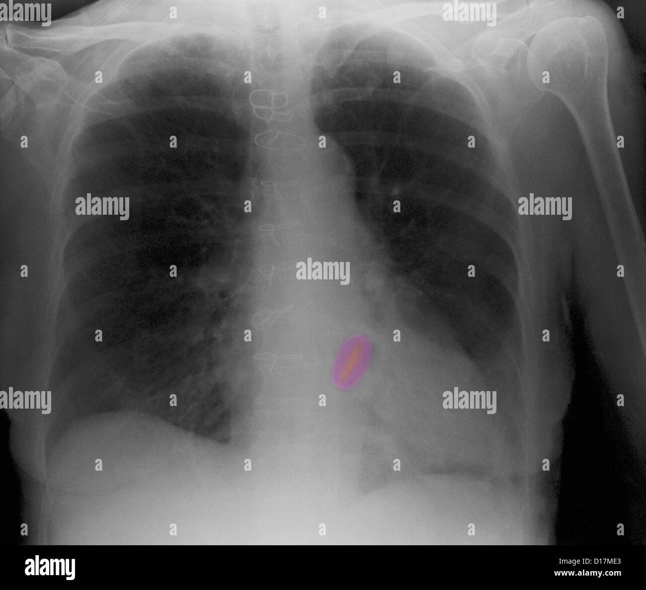 La radiographie d'une femme âgée, remplacement de valve cardiaque Banque D'Images