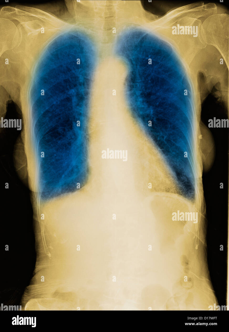 La radiographie d'une femme âgée fumeur avec la MPOC Banque D'Images