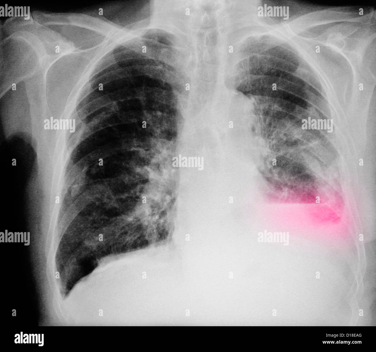Le cancer du poumon, la radiographie du thorax Photo Stock - Alamy