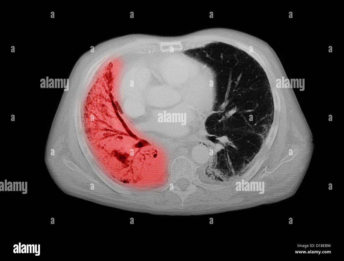 Scanner thoracique, carcinome à petites cellules, la pneumonie Banque D'Images