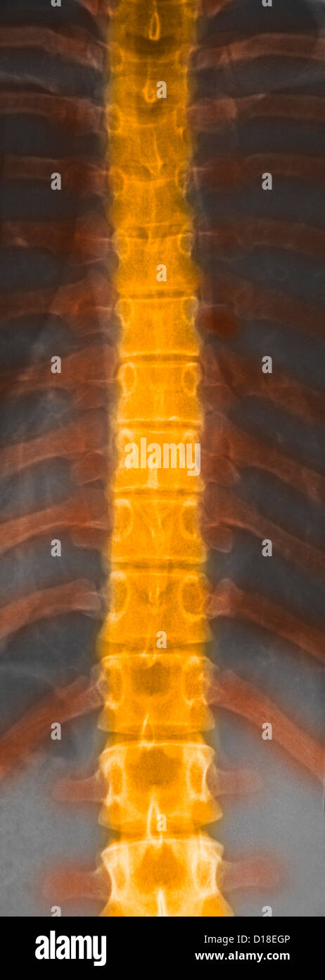 Rayons X normaux de l'épine dorsale de 22 ans Banque D'Images