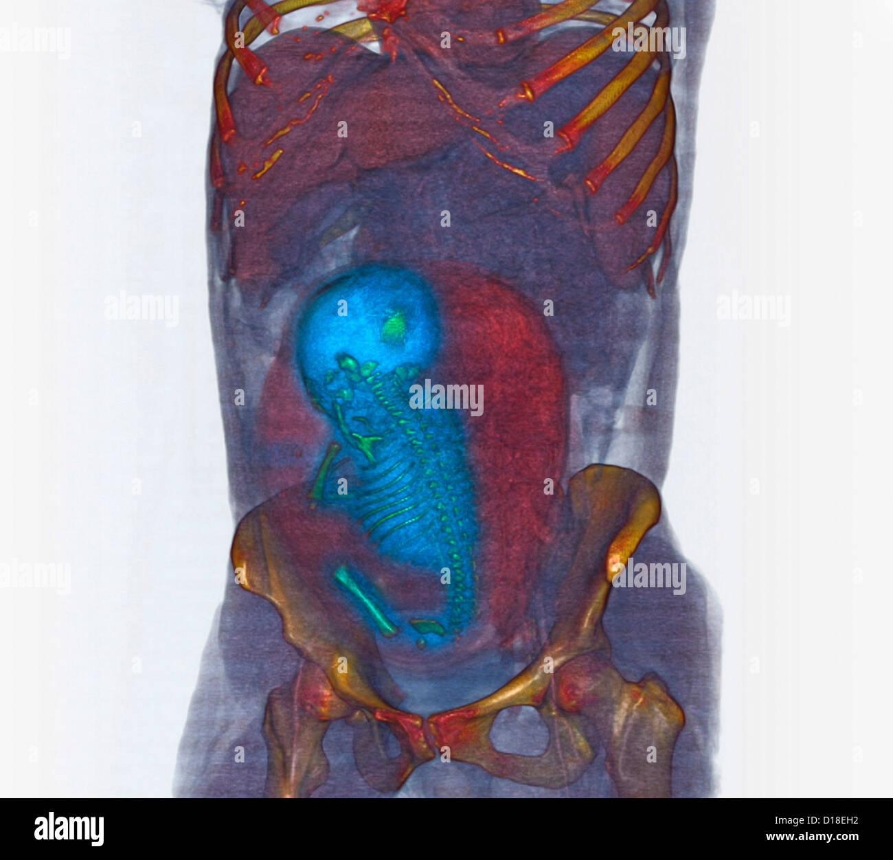 3D CT scan, terme fœtus en siège Banque D'Images
