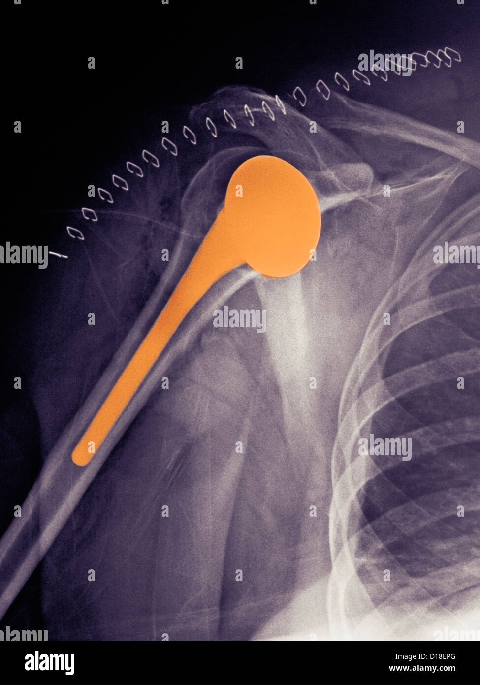 X-ray de remplacement de l'épaule d'une femme de 51 ans Banque D'Images