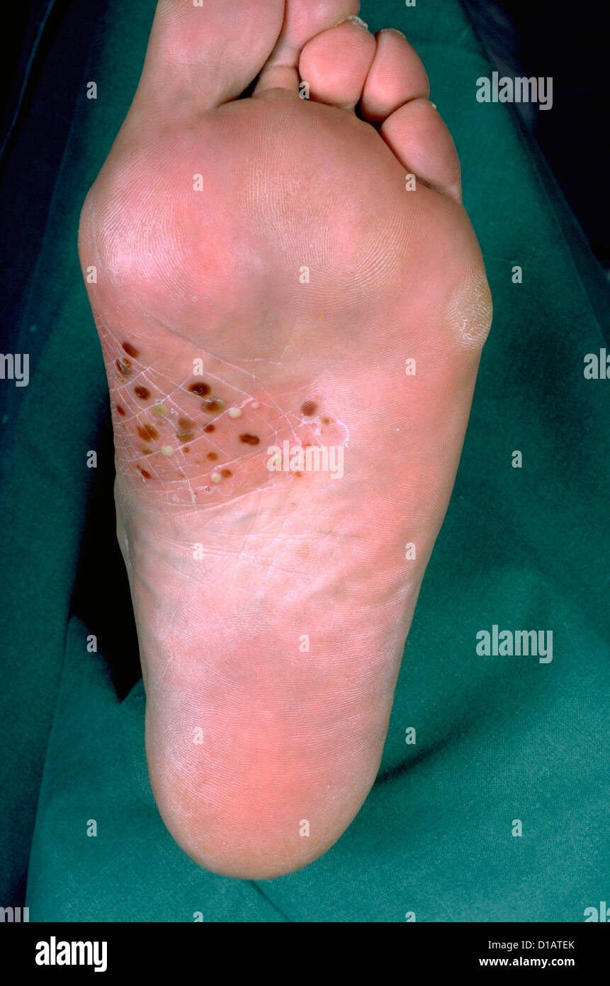 Le psoriasis pustuleux de Photo Stock - Alamy