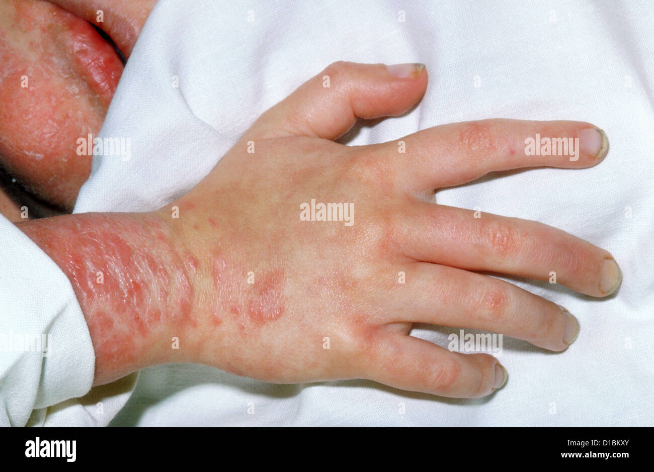 Enfant AVEC LE SYNDROME DE WISKOTT ALDRICH- Banque D'Images