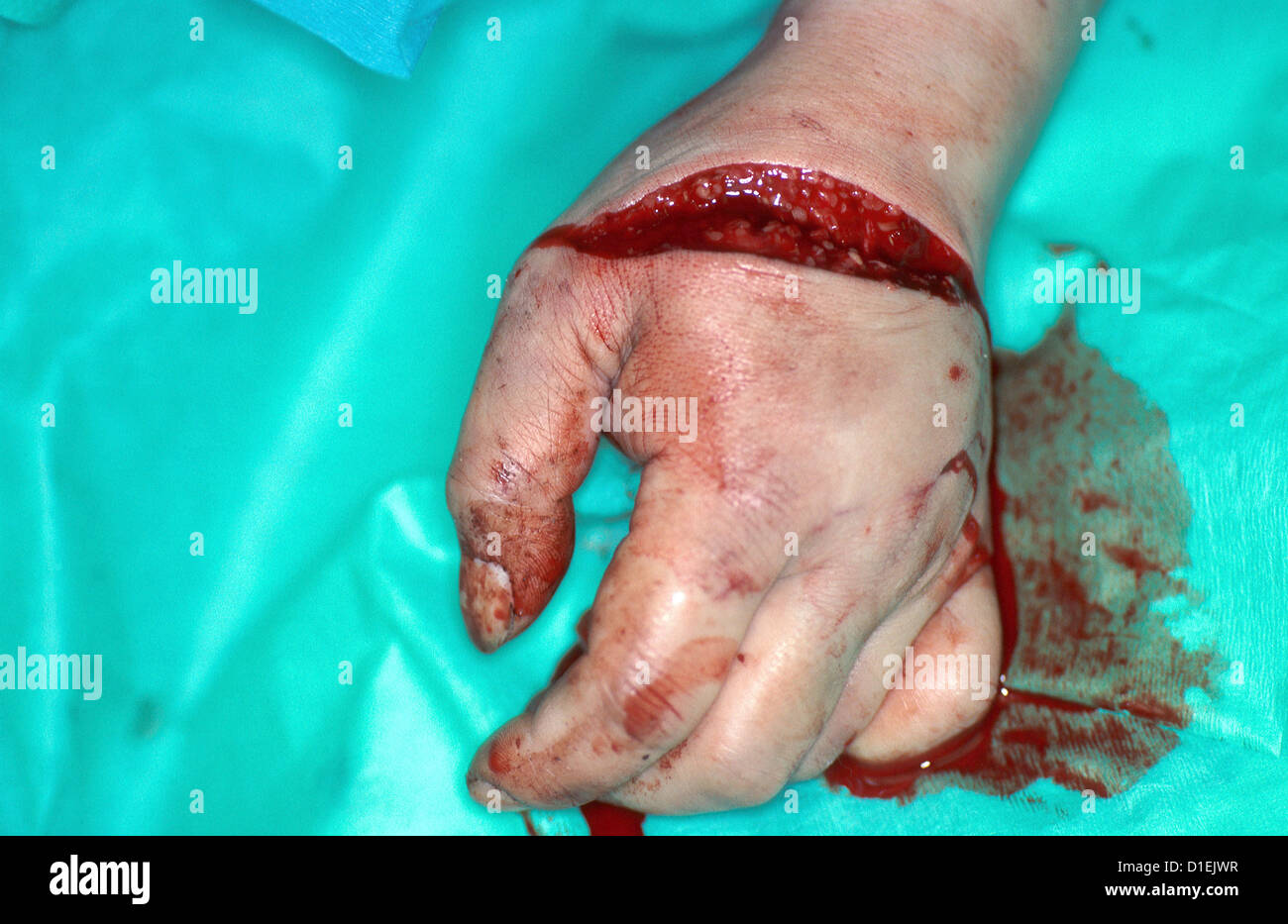 Lacération profonde de la main. Banque D'Images
