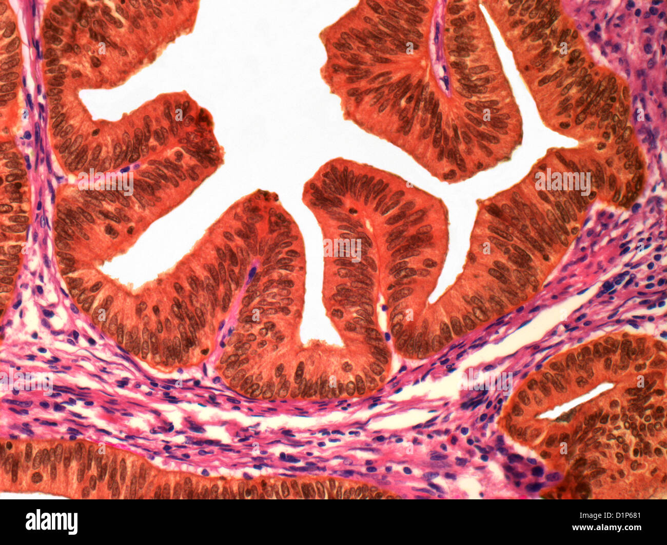 Cancer de l'utérus, la lumière microphotographie Banque D'Images
