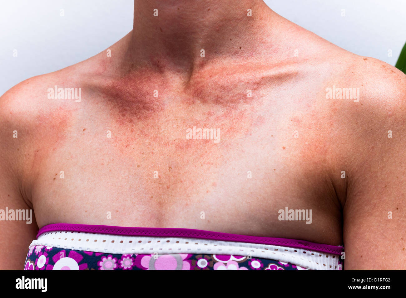 Détail de la peau décolorée au soleil femelle poitrine avec réaction allergique. Banque D'Images
