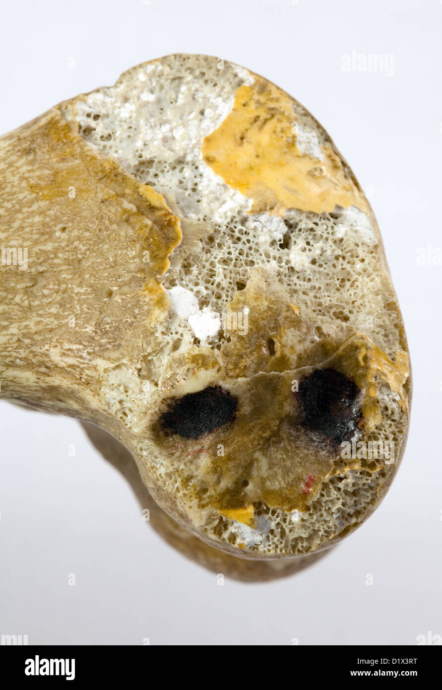 Un de près de l'extrémité inférieure d'un vrai humain fémur, ou os de la cuisse, de montrer ou d'os spongieux spongieux Banque D'Images