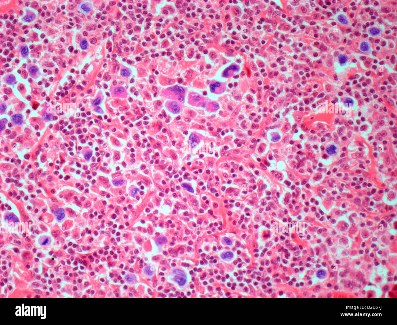 Le lymphome de Hodgkin Lumière Microphotographie d'une section par l'intermédiaire d'un nœud lymphatique touchés par hodgkinien Banque D'Images