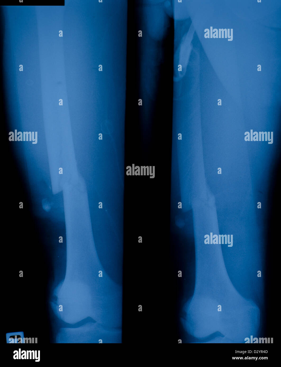 X ray film de fracture du fémur distal. Banque D'Images