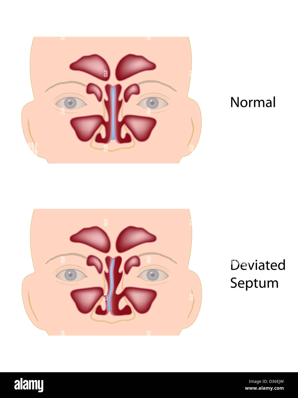Déviation de la cloison nasale Banque D'Images