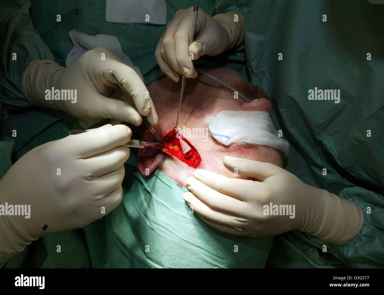 Surgical clips Banque de photographies et d'images à haute résolution -  Alamy