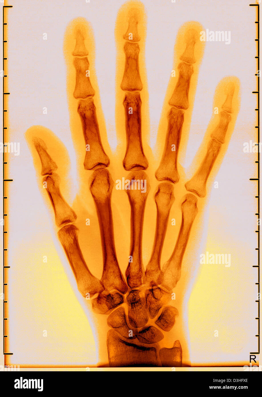 La main de l'enfant, X-RAY Banque D'Images