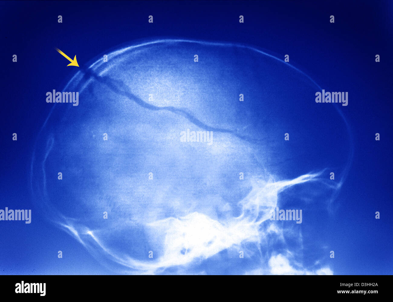 Fracture du crâne, X-RAY Banque D'Images