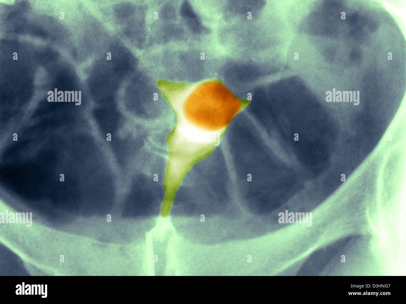 Fibrome utérin, XRAY Photo Stock Alamy