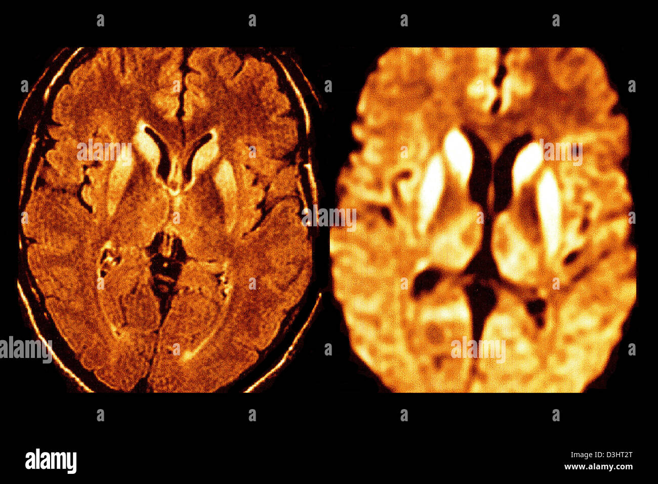 La maladie de Creutzfeldt-jakob, IRM Banque D'Images